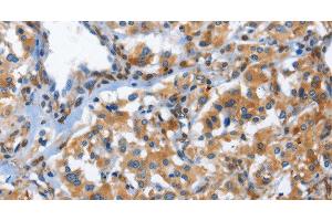 Immunohistochemistry of paraffin-embedded Human thyroid cancer using CD244 Polyclonal Antibody at dilution of 1:50