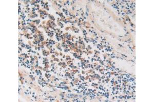 IHC-P analysis of stomach cancer tissue, with DAB staining. (PKIG Antikörper  (AA 1-76))