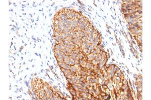 Formalin-fixed, paraffin-embedded human Bladder Carcinoma stained with Thrombomodulin Monoclonal/CD141 Antibody (THBD/1591). (Thrombomodulin Antikörper  (AA 69-194))