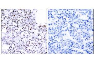 Immunohistochemical analysis of paraffin-embedded human breast carcinoma tissue using SMC1 (Ab-957) antibody (E021190). (SMC1A Antikörper)