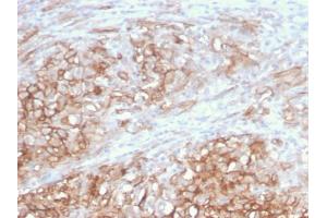Formalin-fixed, paraffin-embedded human Melanoma stained with MCAM Mouse Monoclonal Antibody (MCAM/3046). (MCAM Antikörper  (AA 226-374))