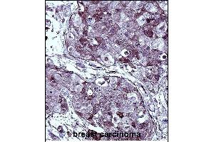 TYSY Antibody (C-term) immunohistochemistry analysis in formalin fixed and paraffin embedded human breast carcinoma followed by peroxidase conjugation of the secondary antibody and DAB staining. (TYMS Antikörper  (C-Term))