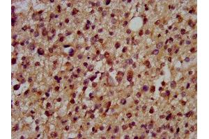 IHC image of ABIN7150649 diluted at 1:200 and staining in paraffin-embedded human glioma performed on a Leica BondTM system. (DSCAM Antikörper  (AA 1711-1867))