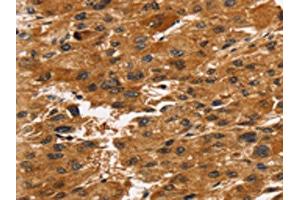 The image on the left is immunohistochemistry of paraffin-embedded Human liver cancer tissue using ABIN7192726(TACC2 Antibody) at dilution 1/30, on the right is treated with synthetic peptide. (TACC2 Antikörper)