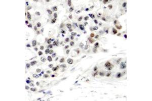 Immunohistochemistry (IHC) image for anti-Estrogen Receptor 1 (ESR1) (pSer106) antibody (ABIN3020205) (Estrogen Receptor alpha Antikörper  (pSer106))