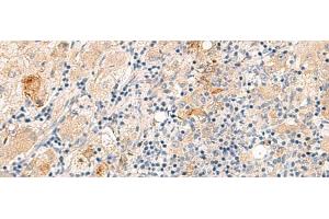 Immunohistochemistry of paraffin-embedded Human liver cancer tissue using THNSL1 Polyclonal Antibody at dilution of 1:70(x200) (THNSL1 Antikörper)