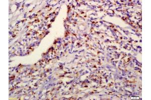 Formalin-fixed and paraffin embedded human laryngocarcinoma labeled with Anti-PPM1D Polyclonal Antibody, Unconjugated (ABIN740415) at 1:200 followed by conjugation to the secondary antibody and DAB staining (PPM1D Antikörper  (AA 201-300))