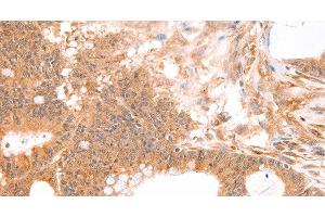 Immunohistochemistry of paraffin-embedded Human colon cancer tissue using TNF beta Polyclonal Antibody at dilution 1:50 (LTA Antikörper)