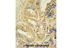 TLL1 antibody (C-term) immunohistochemistry analysis in formalin fixed and paraffin embedded human prostate carcinoma followed by peroxidase conjugation of the secondary antibody and DAB staining. (TLL1 Antikörper  (C-Term))