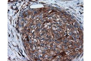 Immunohistochemical staining of paraffin-embedded Carcinoma of liver tissue using anti-RC201933 mouse monoclonal antibody. (PIM2 Antikörper)