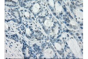 Immunohistochemical staining of paraffin-embedded Adenocarcinoma of colon tissue using anti-CRYABmouse monoclonal antibody. (CRYAB Antikörper)
