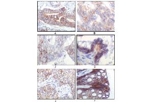 Immunohistochemical analysis of paraffin-embedded human gastric adenocarcinoma(A), colon adenocarcinoma(B), endometrial carcinoma(uterus)(C), ovary adenocarcinoma(D), lung squamous cell carcinoma(E), stomach epithelium mucosae(F), showing membrane localization using IGF1R-Beta mouse mAb with DAB staining. (IGF1R-beta Antikörper)