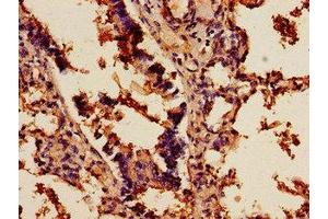 Immunohistochemistry of paraffin-embedded human lung cancer using ABIN7143196 at dilution of 1:100 (SCD Antikörper  (AA 10-70))