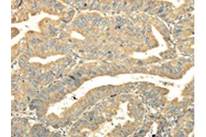 The image on the left is immunohistochemistry of paraffin-embedded Human esophagus cancer tissue using ABIN7131516(TULP2 Antibody) at dilution 1/20, on the right is treated with fusion protein. (TULP2 Antikörper)