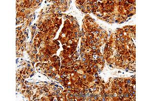 Immunohistochemistry of Human liver cancer using COX19 Polyclonal Antibody at dilution of 1:50 (COX19 Antikörper)