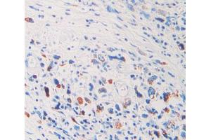 IHC-P analysis of stomach cancer tissue, with DAB staining. (FIL1d Antikörper  (AA 12-151))