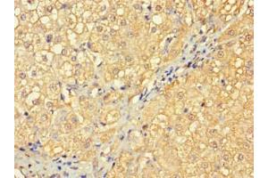 Immunohistochemistry of paraffin-embedded human liver cancer using ABIN7166961 at dilution of 1:100 (RABGAP1L Antikörper  (Isoform 10))