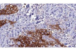 ABIN6278038 at 1/100 staining Human Head and neck cancer tissue by IHC-P. (CD72 Antikörper  (Internal Region))