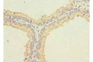 Immunohistochemistry of paraffin-embedded human prostate cancer using ABIN7169984 at dilution of 1:100 (SLC6A15 Antikörper  (AA 357-452))