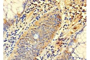 Immunohistochemistry of paraffin-embedded human colon cancer using ABIN7171165 at dilution of 1:100 (SYTL3 Antikörper  (AA 1-300))