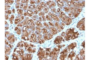 Formalin-fixed, paraffin-embedded human Stomach Carcinoma stained with MUC1 Rabbit Recombinant Monoclonal Antibody (MUC1/2818R).