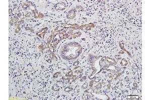 Formalin-fixed and paraffin embedded human colon cancer labeled with Anti-EDG4/LPA2 Polyclonal Antibody, Unconjugated (ABIN681118) at 1:400 followed by conjugation to the secondary antibody and DAB staining (EDG4 Antikörper)