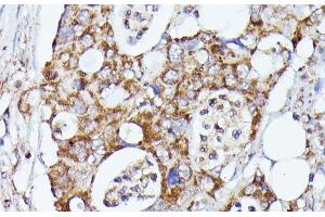 Immunohistochemistry of paraffin-embedded Human colon carcinoma using CDK5RAP1 Polyclonal Antibody at dilution of 1:100 (40x lens). (CDK5RAP1 Antikörper)