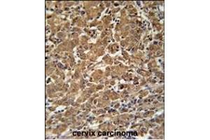 N4BP3 Antibody (N-term) (ABIN651821 and ABIN2840413) immunohistochemistry analysis in formalin fixed and paraffin embedded human cervix carcinoma followed by peroxidase conjugation of the secondary antibody and DAB staining. (N4BP3 Antikörper  (N-Term))