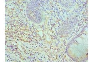 Immunohistochemistry of paraffin-embedded human colon cancer using ABIN7171057 at dilution of 1:100