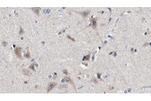 ABIN6272845 at 1/100 staining Human brain cancer tissue by IHC-P. (IFT88 Antikörper  (C-Term))