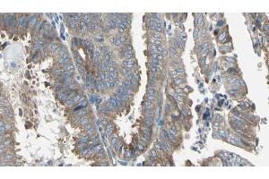 ABIN6274763 at 1/100 staining Human cervical cancer tissue by IHC-P. (AZI1 Antikörper  (C-Term))