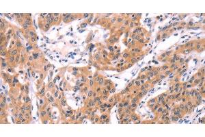 Immunohistochemistry of paraffin-embedded Human lung cancer using SERPINA5 Polyclonal Antibody at dilution of 1:40 (SERPINA5 Antikörper)