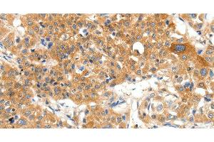 Immunohistochemistry of paraffin-embedded Human lung cancer using PLAT Polyclonal Antibody at dilution of 1:50 (PLAT Antikörper)