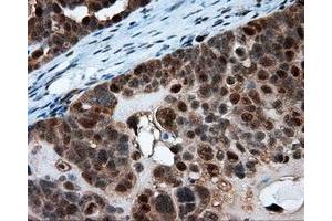 Immunohistochemical staining of paraffin-embedded Adenocarcinoma of breast tissue using anti-SRR mouse monoclonal antibody. (SRR Antikörper)