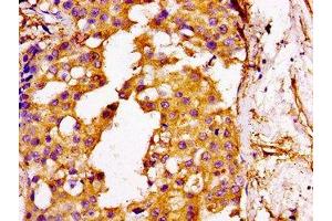 IHC image of ABIN7175537 diluted at 1:100 and staining in paraffin-embedded human breast cancer performed on a Leica BondTM system. (GGCX Antikörper  (AA 383-526))