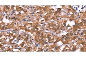 Immunohistochemistry of paraffin-embedded Human thyroid cancer tissue using AMER1 Polyclonal Antibody at dilution 1:40