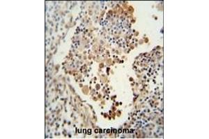 CADM1 antibody (N-term) (ABIN654660 and ABIN2844356) immunohistochemistry analysis in formalin fixed and paraffin embedded human lung carcinoma followed by peroxidase conjugation of the secondary antibody and DAB staining. (CADM1 Antikörper  (N-Term))