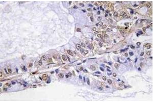 Immunohistochemistry (IHC) analyzes of p-Cofilin in paraffin-embedded human lung carcinoma tissue. (Cofilin Antikörper  (pSer3))