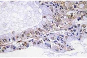 Immunohistochemistry (IHC) analyzes of p-Cofilin in paraffin-embedded human lung carcinoma tissue. (Cofilin Antikörper  (pSer3))
