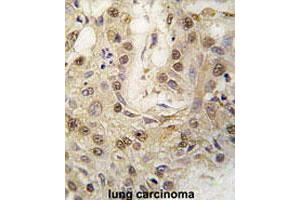 Formalin-fixed and paraffin-embedded human lung carcinomareacted with PRKG2 polyclonal antibody , which was peroxidase-conjugated to the secondary antibody, followed by AEC staining. (PRKG2 Antikörper  (C-Term))