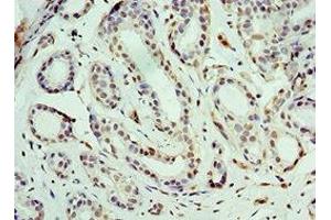 Immunohistochemistry of paraffin-embedded human breast cancer using ABIN7164185 at dilution of 1:100 (BCAS2 Antikörper  (AA 1-225))