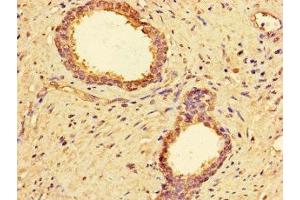Immunohistochemistry of paraffin-embedded human prostate cancer using ABIN7142866 at dilution of 1:100 (MMP2 Antikörper  (AA 445-660))