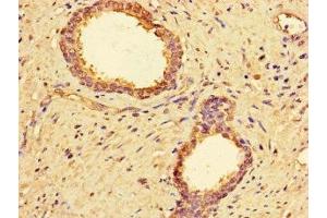Immunohistochemistry of paraffin-embedded human prostate cancer using ABIN7142866 at dilution of 1:100