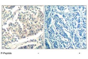 Immunohistochemical analysis of paraffin-embedded human breast carcinoma tissue using ABL1/ABL2 (phospho Y393/429) polyclonal antibody . (ABL1 Antikörper  (pTyr393, pTyr429))