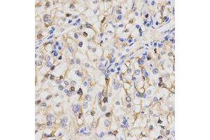 Immunohistochemistry of paraffin-embedded human kidney cancer using PPP2R4 Antibody. (PPP2R4 Antikörper)