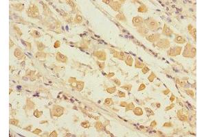 Immunohistochemistry of paraffin-embedded human gastric cancer using ABIN7168232 at dilution of 1:100 (RCHY1 Antikörper  (AA 1-261))
