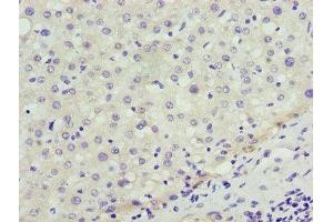Immunohistochemistry of paraffin-embedded human liver cancer using ABIN7151358 at dilution of 1:100 (ENOX1 Antikörper  (AA 101-340))