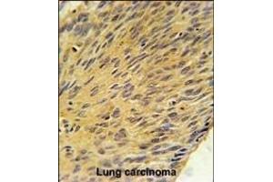 MURC Antibody (N-term) (ABIN651833 and ABIN2840416) immunohistochemistry analysis in formalin fixed and paraffin embedded human lung carcinoma followed by peroxidase conjugation of the secondary antibody and DAB staining. (MURC Antikörper  (N-Term))