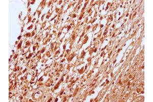 IHC image of ABIN7127796 diluted at 1:100 and staining in paraffin-embedded human melanoma cancer performed on a Leica BondTM system. (Rekombinanter RNF2 Antikörper)