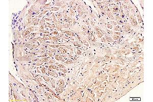 Formalin-fixed and paraffin embedded human myocardium tissue labeled with Anti-Collagen III Polyclonal Antibody (ABIN669981), Unconjugated at 1:400, followed by conjugation to the secondary antibody and DAB staining (COL3 Antikörper  (AA 1301-1400))